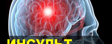 ИНСУЛЬТ