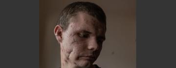 Мешканець Білгород-Дністровського став одним із 35-ти пацієнтів американсько-української хірургічної місії в Івано-Франківській обласній лікарні