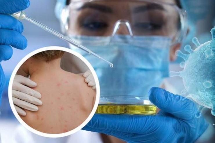 УКРАЇНА ОТРИМАЛА 10 ТИС ДОЗ ВАКЦИНИ ВІД ВІСПИ МАВП – МОЗ