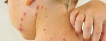 Ситуація зі спалахом кору на Одещині