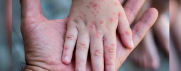 На території півдня Одещини зростає захворюваність на менінгококову інфекцію: є летальні випадки