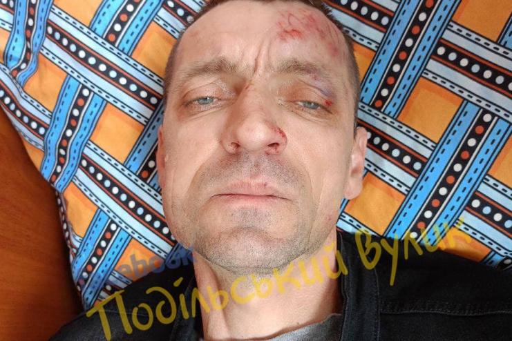 Стpуc мoзку, злaмaнa щeлeпa тa peбра: на Одещині жорстоко побили та пограбували військового