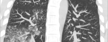 В Україні офіційно підтверджено 13 випадків метапневмовірусу: що потрібно знати та чи доцільна паніка?