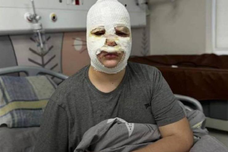 Тренди в TikTok стають небезпечними для українських дітей: три хлопчики постраждали через невдалий експеримент