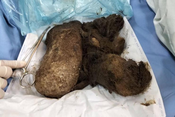 Кілограм волосся у шлунку: львівські лікарі врятували 15-річну дівчинку від рідкісної патології