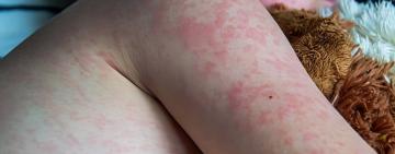 Спалах кору в Ізмаїльському районі: що відомо і як захиститися