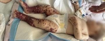 Лікарське диво: у Чернівцях лікарі врятували немовля з критичною формою менінгококової інфекції