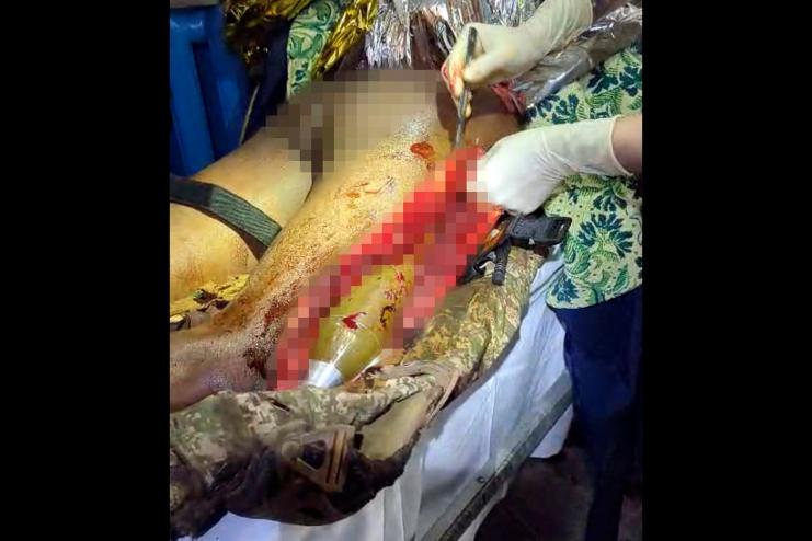 Операція разом із саперами: у нозі пораненого бійця виявили протитанкову гранату