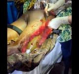 Операція разом із саперами: у нозі пораненого бійця виявили протитанкову гранату